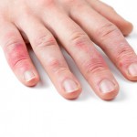 Haut an den Fingern reagiert allergisch auf bestimmte Stoffe
